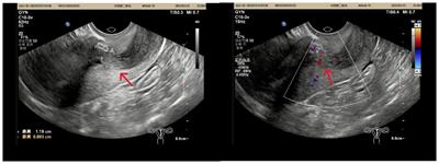 Case report: An atypical case of uterine adenosarcoma with extensive bizarre stromal cells and amplification of MDM2